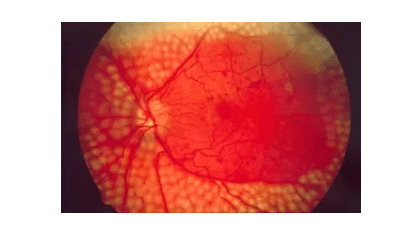 Retina lézeres kezelés