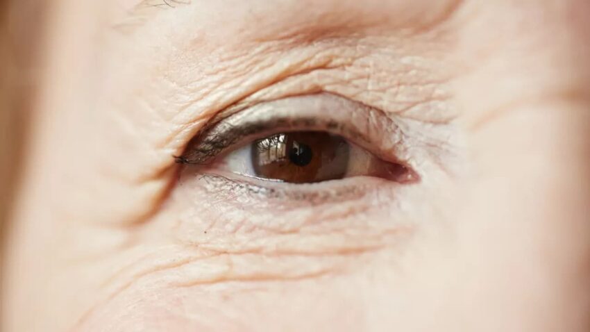 megereszkedett szemhéjbőr